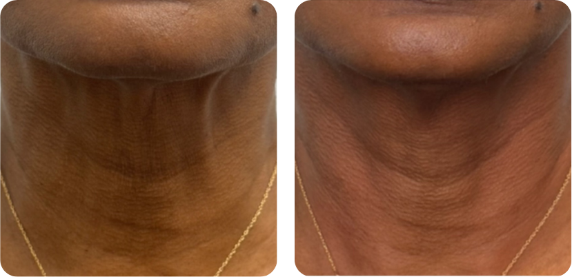 Before and after comparison after 1 wrinkle reduction treatment