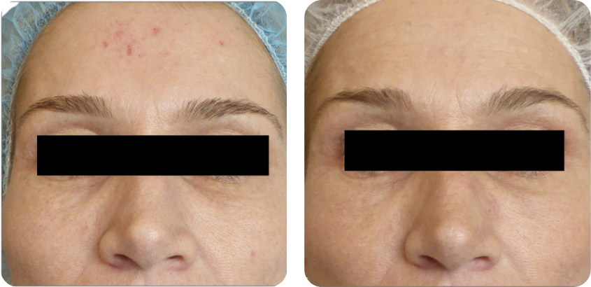 Before and after comparison after 3 skin resurfacing treatments