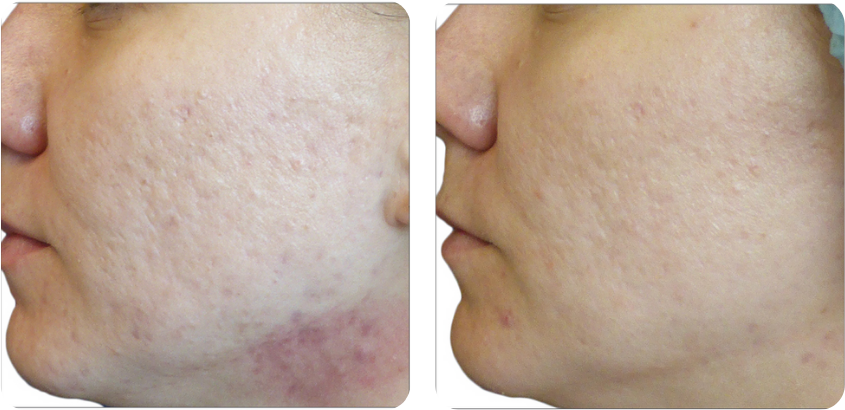 Before and after comparison after 3 skin resurfacing treatments